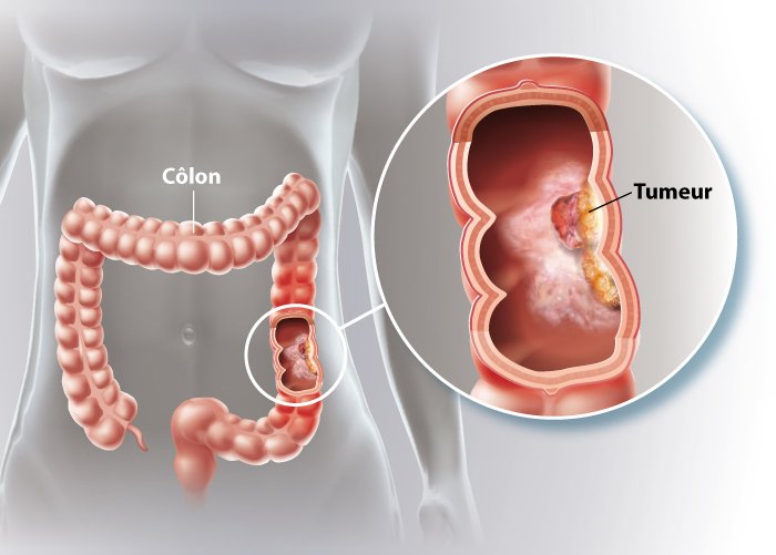 cancer colon