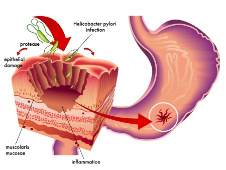 Gastrite à helicobacter pylori | PODIPS