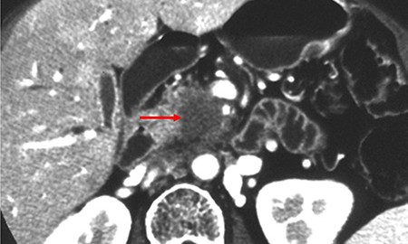 tumeur pancreas