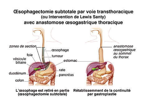 oesophagectomie sub-totale