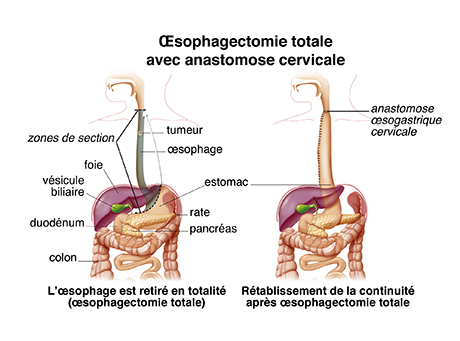 oesophagectomie totale