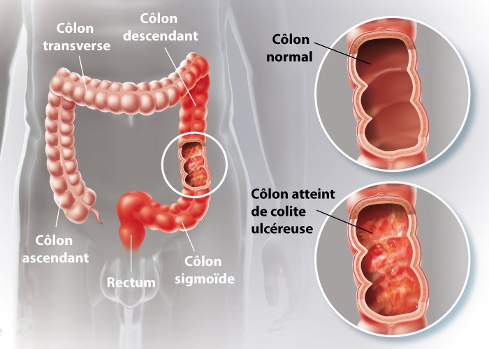 Maladies inflammatoires chroniques intestinales (MICI) - Passe