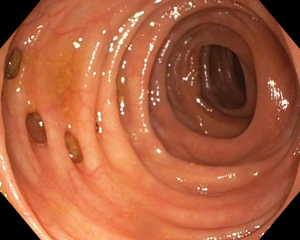 Diverticules coliques