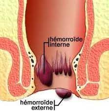 hemorroides