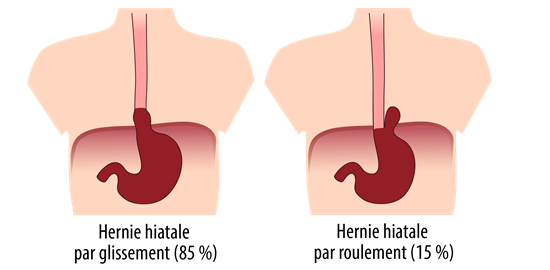 hernie hiatale