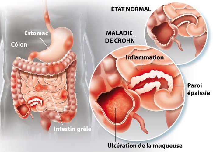 Crohn