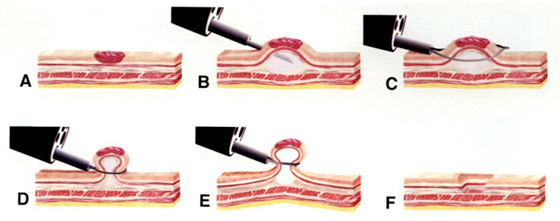 Mucosectomie