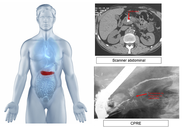 Calcification pancréatique au scanner et sténose du canal de Wirsung en CPRE