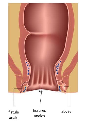 procto fissure anale