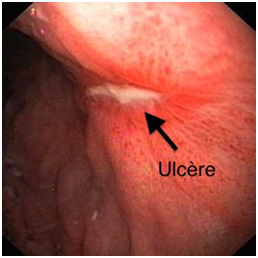 ulcère